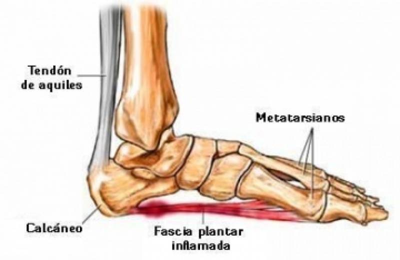 Fascitis plantar anatomia