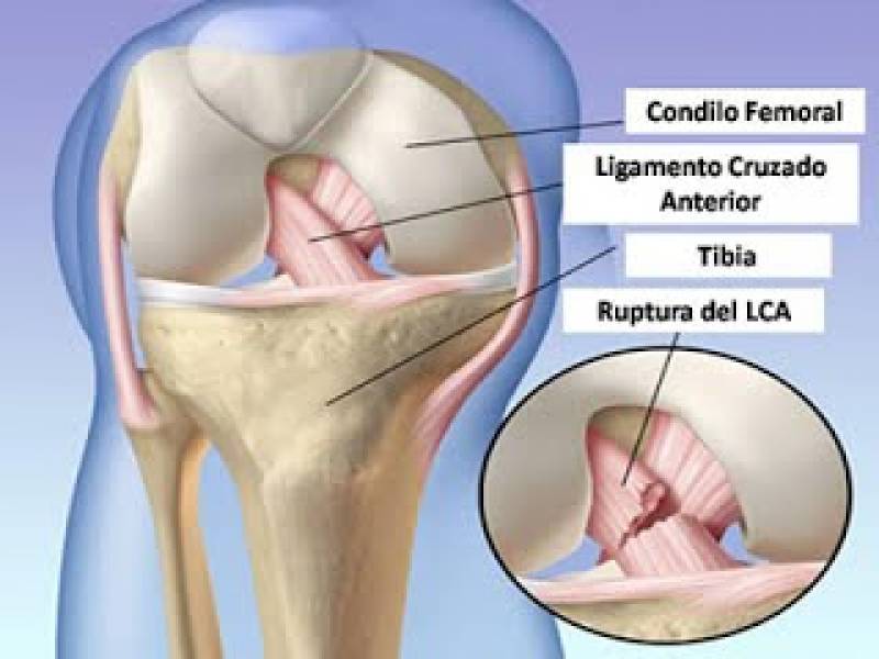 Se puede conducir con el ligamento cruzado anterior roto